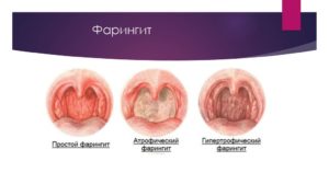 Вторичный хронический фарингит