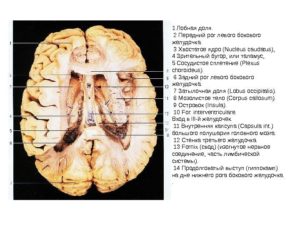 Дистанция затылочных рогов боковых желудочков