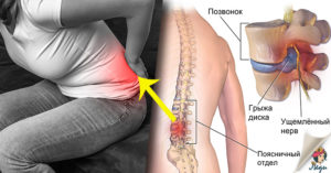 Дискоз поясничного отдела позвоночника, ноет поясница, помогите разобраться