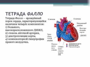 ВПС ДМЖП, ТМС, гипоплазия Легочной артерии