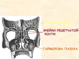 Вросшая ячейка решётчатой кости правой лобной пазухи