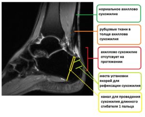 МРТ при ахиллобурсите