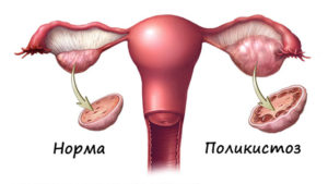 Врач ставит поликистоз