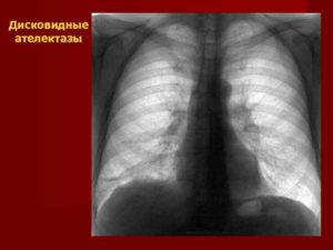 Дисковидный ателектаз над диафрагмой слева