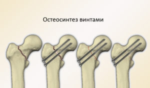 Металлоостеосинтез канюлированными винтами перелома шейки бедра
