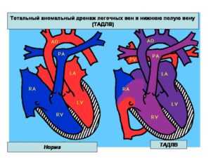 Венозный дренаж