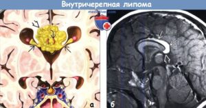Дисгенезия мозолистого тела, Перикаллезная липома