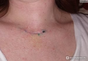 Давление после операции удаления щитовидки