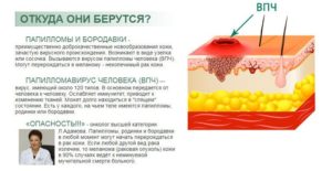 Можно ли при помощи поднятия иммунитета удалить впч из организма