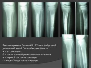 Метафизарная дисплазия млевой берцовой кости
