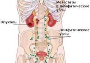 Метастазы в лимфоузлы от почки