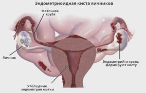 Эндометриоидная Киста левого яичника (операция)