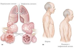 Эмфизема легких, хрип и бульканье в лежачем положении