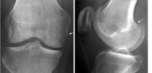 Краевой перелом надколенника, краевой перелом латерального мыщелка бедренной кости