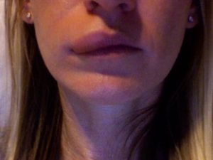 Мурашки на лице, онемение губы