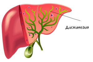 Дискинезия желчевыводящих путей