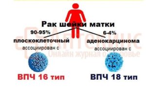 ВПЧ 16 и подготовка к эко