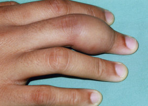 Воспаление пальца и болит рука