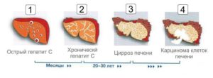 Возможна ли температура при гепатите с