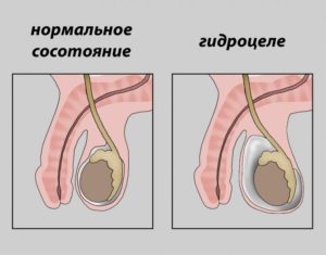 Водянка яичка рецидив