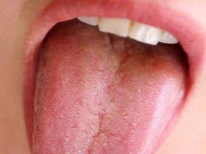 Дисбактериоз налет на языке