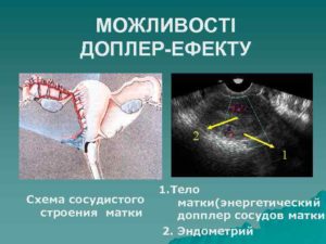 Допрел сосудов матки