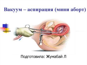 Вакуумный аборт
