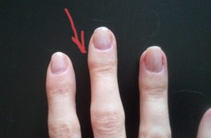 На суставе среднего пальца выросла шишка