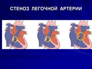 ВПС стеноз легочной артерии