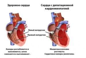 Дилатационная кардиомиопатия, нарушение ритма. Армия