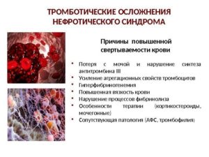 Высокие тромбоциты лечение