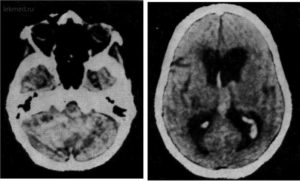 Микрокровоизлияния в левой гемисфере мозжечка