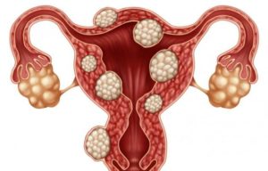 Миома матки и патология эндометрия