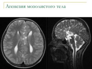 ВПР ЦНС: сужение полости прозрачной перегородки, гипоплазия мозолистого тела