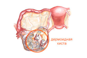 Дермоидная киста