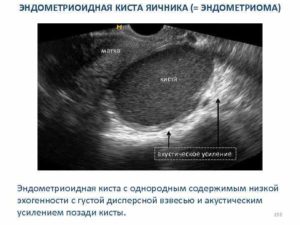 Дюфастон и эндометриоиная киста пр. Яичника