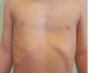 Деформация грудной клетки у ребенка после операци