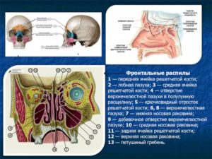Вросшая ячейка решётчатой кости правой лобной пазухи