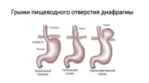 Чем лечить ГЭРБ 1 степени и ГПОД 1 степени