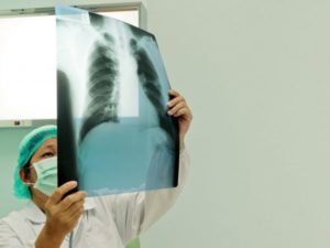 Может ли рентген спровоцировать развие онкологии