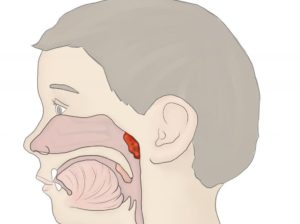 Воспаление миндалины справа. Боли при открывании рта