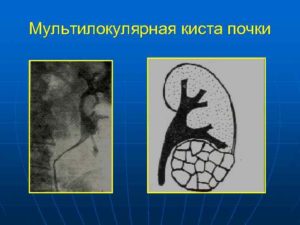 Мультилокулярная киста почки