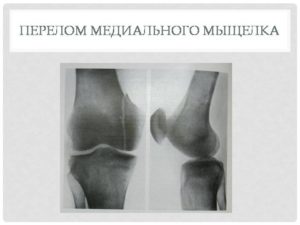 Краевой перелом надколенника, краевой перелом латерального мыщелка бедренной кости