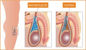 Варикоцеле 1 или 3 группа здоровья