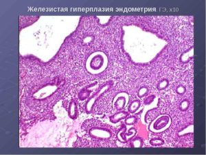 Внутренний эндометриоз и железистая гиперплазия эндометрия