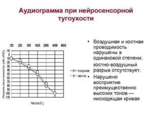 Временное улучшение слуха при нейросенсорной тугоухости