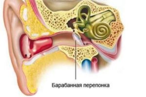 Дырочка в барабанной перепонке