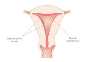 Возможно ли зачатие при тонком эндометрии