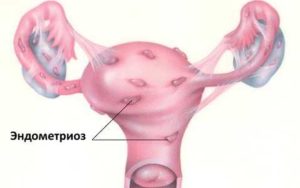 Вторичное бесплодие, эндометриоз и жанин