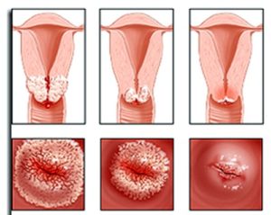 Эрозия шейки матки